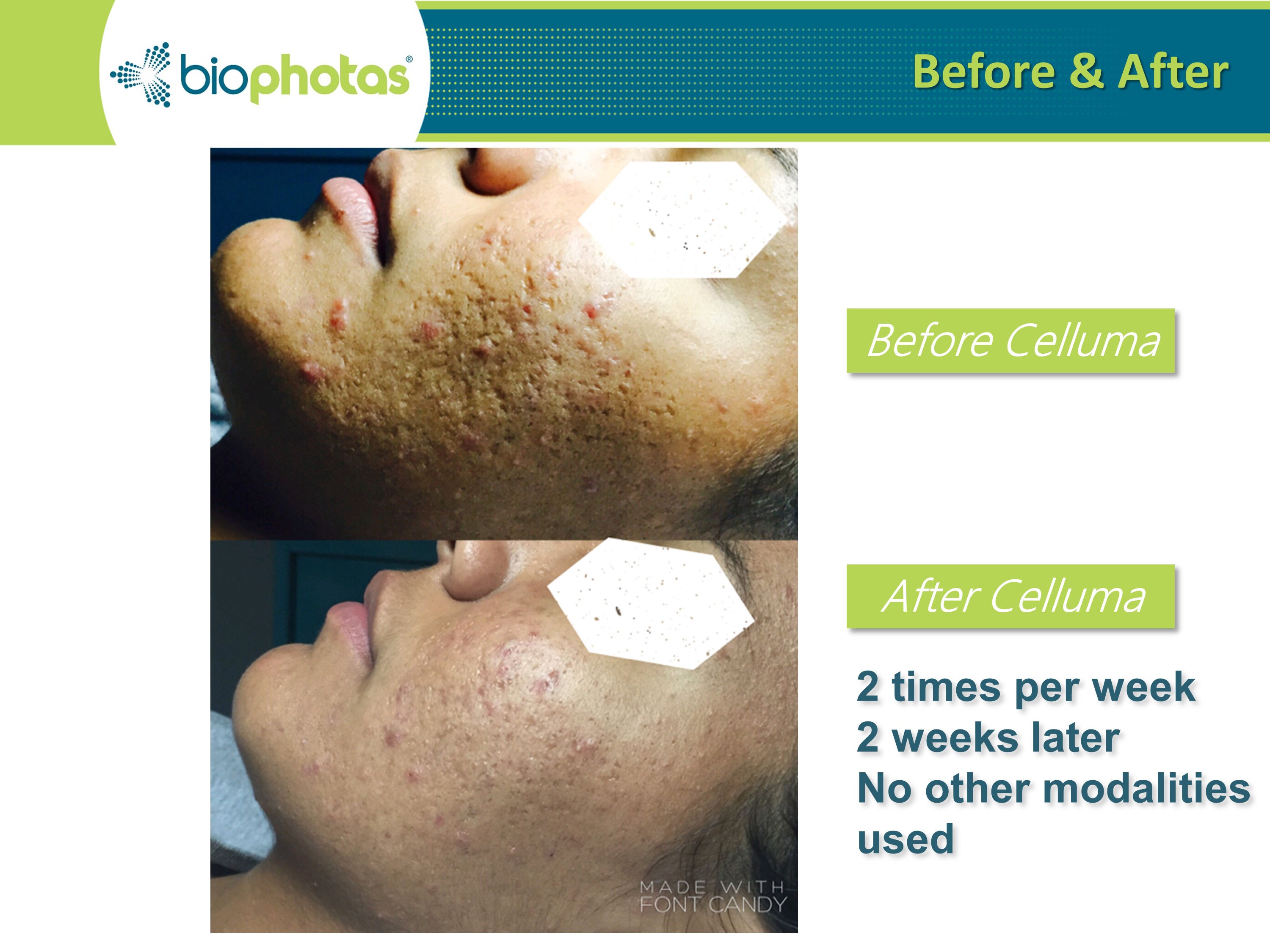 before-after-acne-3.jpg